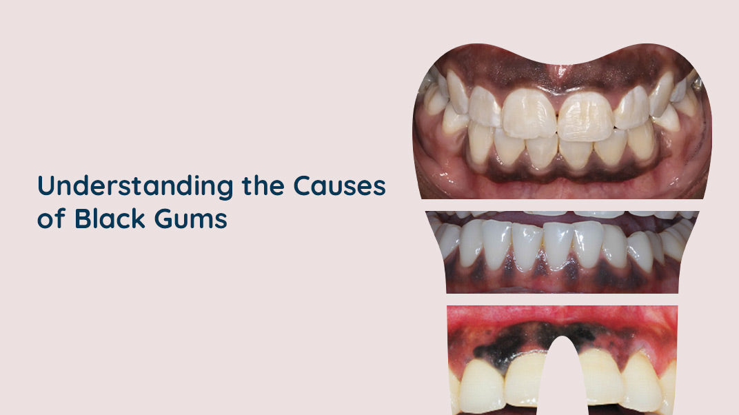 What Causes Black Gums?