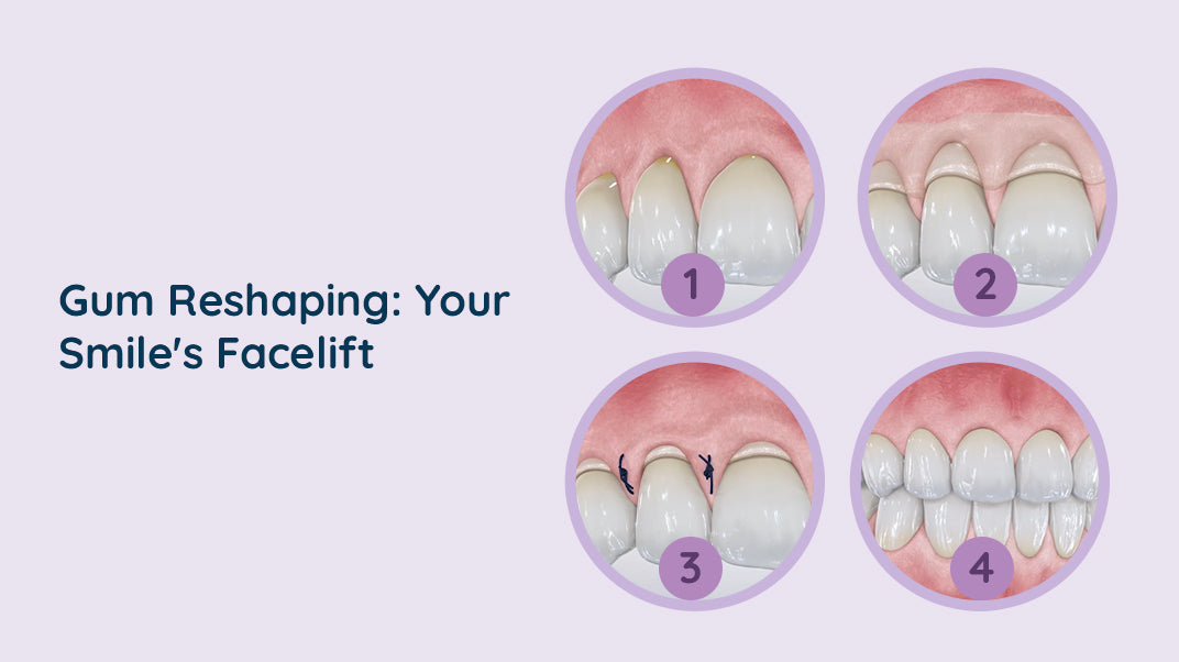 What Is Gum Reshaping?