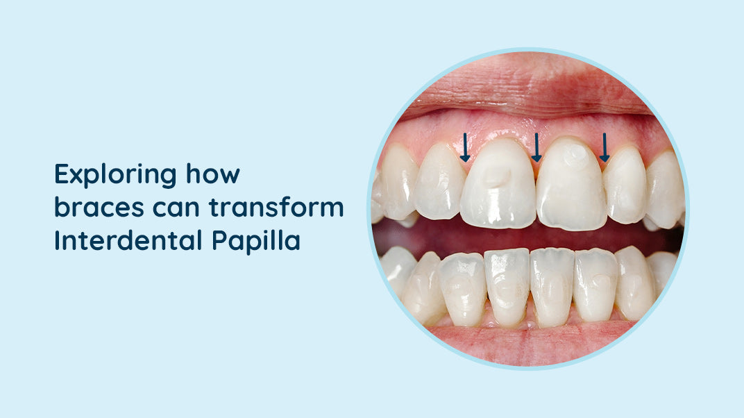 Can Braces help reduce Interdental Papilla