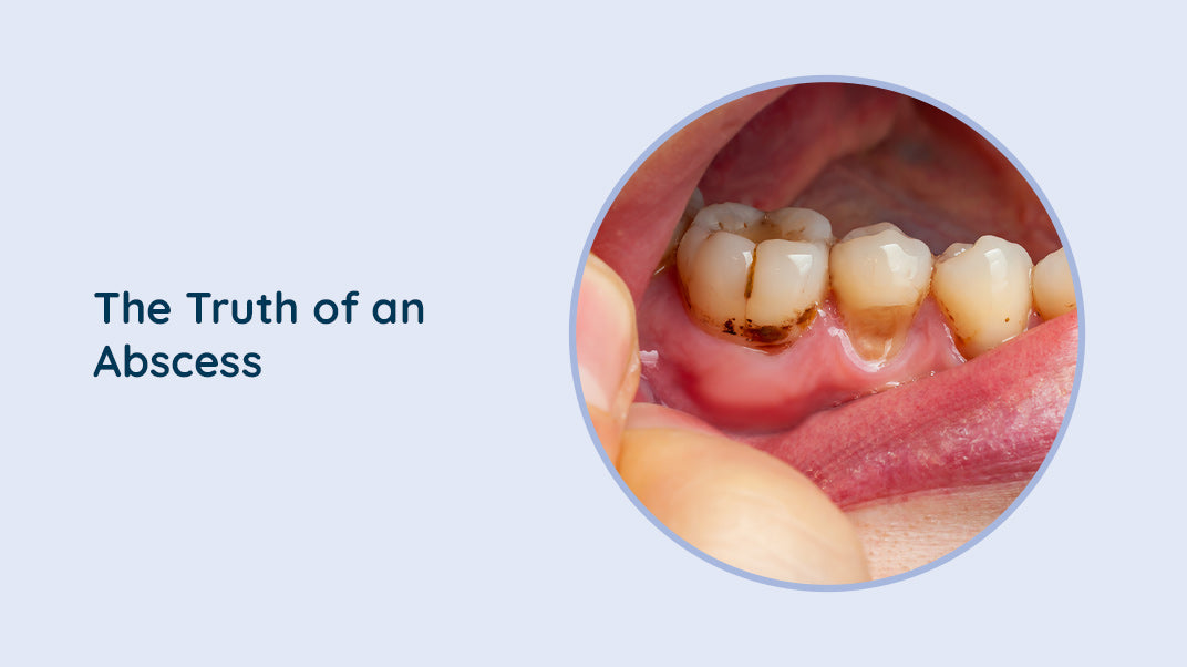 Effects of Abscessed Teeth on Oral Health
