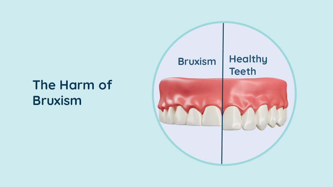 Bruxism: Uncovering the Dangers of Teeth Grinding