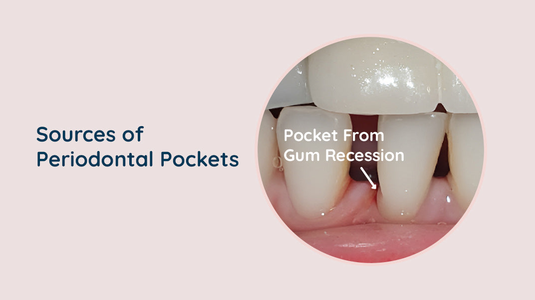 What causes Periodontal Pockets ?, electric toothbrush, dental flosser