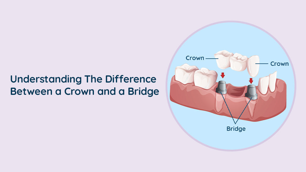 What Is The Difference Between a Crown and a Bridge ?