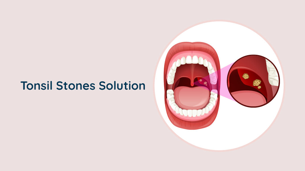 Could an Oral Irrigator Remove Tonsil Stones ?