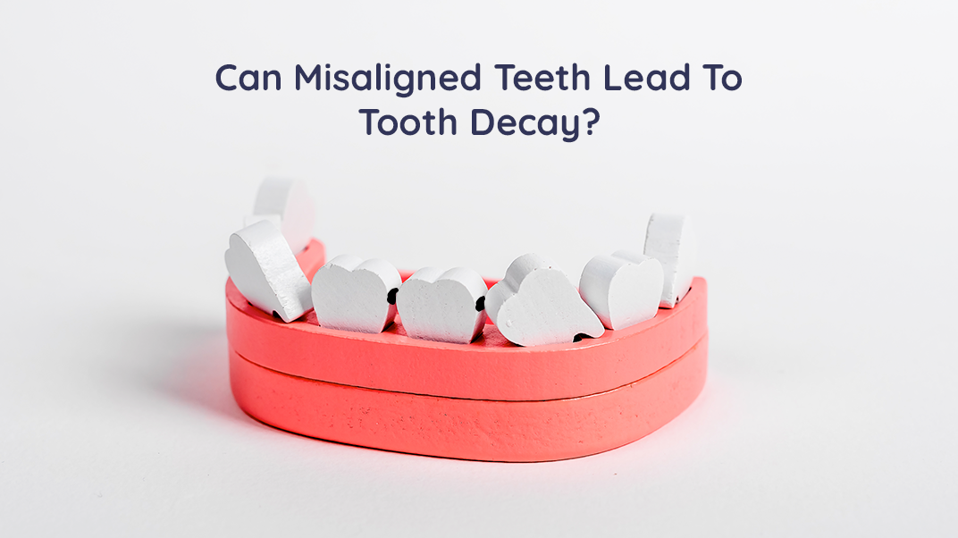 How Does Misalignment of Teeth Could Lead To Tooth Decay? – ORACURA