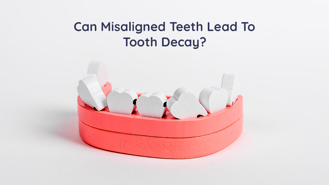 Did You Know: Your Misalignment Could Lead To Tooth Decay?