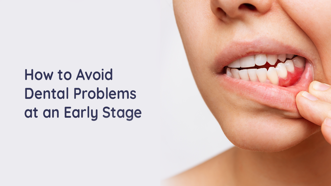 How to Avoid Dental Problems at an Early Stage