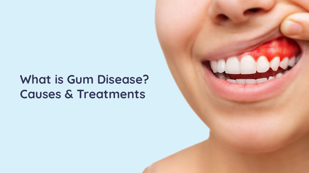 Gum Disease: Causes And Treatments