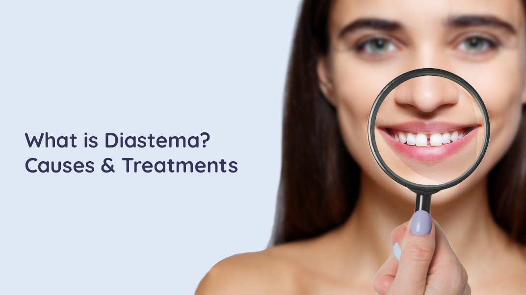 Diastema: Understanding The Causes of Gap In Front Teeth