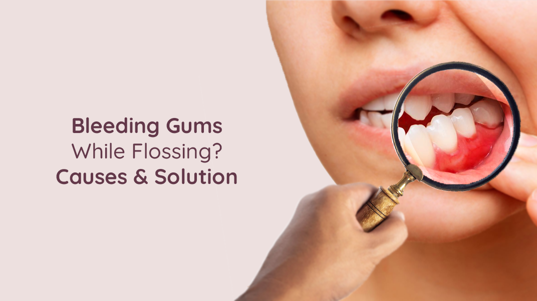 Causes of Bleeding Gums When Flossing