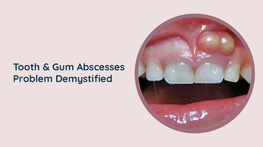 Tooth & Gum Abscesses Problem Demystified