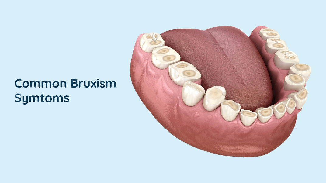 Signs You May Have Bruxism