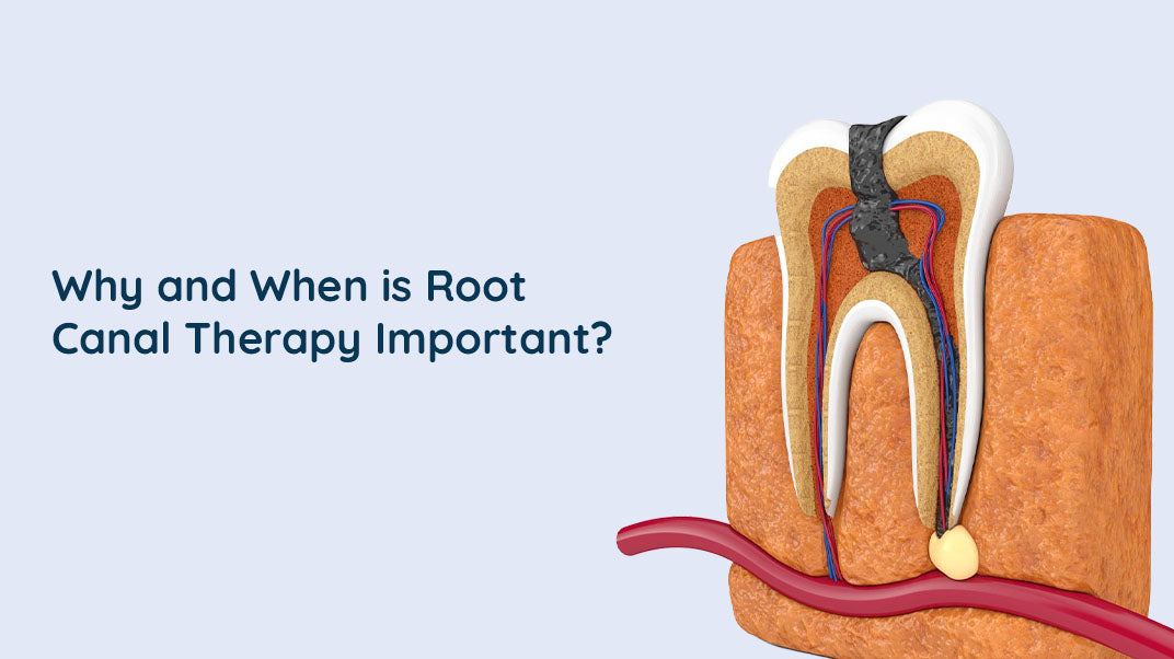 Why and When is Root Canal Therapy Important? |ORACURA