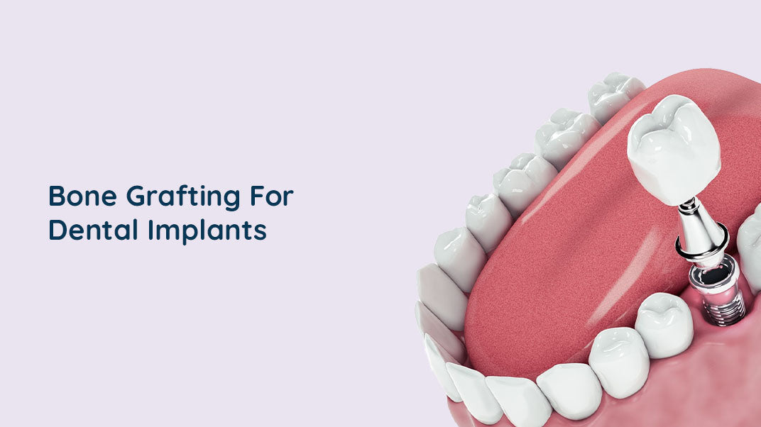 Do You Need Bone Grafting for Dental Implants?
