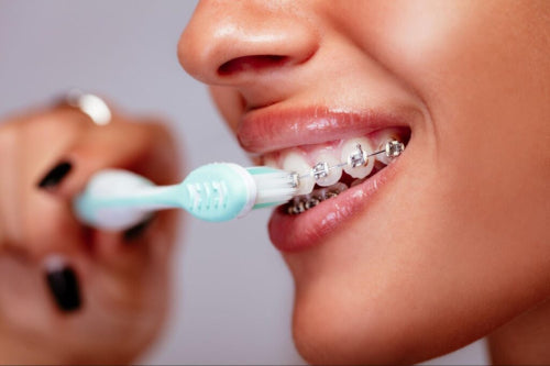 Oral Irrigation Strategies for Patients With Braces