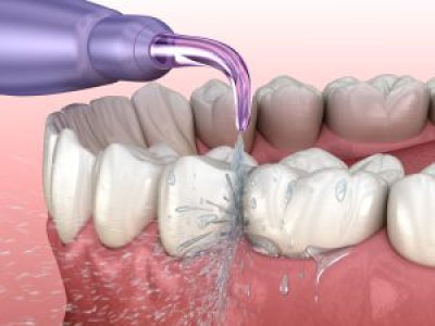 Water Flosser Studies: Long-Term Oral Health Benefits